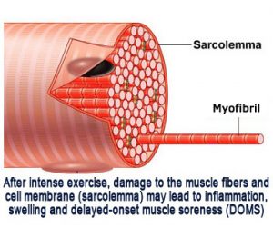 muscle-cell-DOMS